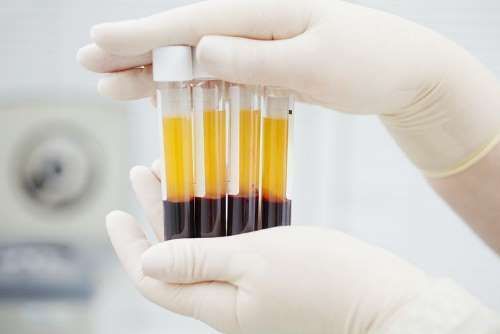 sangre plaquetas analisis