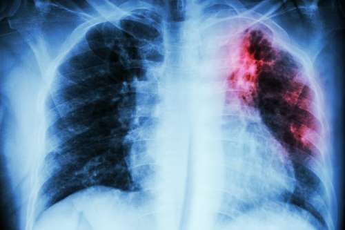 tuberculosis