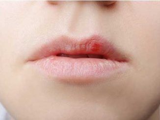 Herpes labial: siete de cada diez españoles podrían desarrollarlo